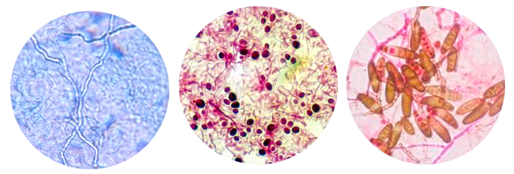 Вид ногтя пораженного грибком под микроскопом