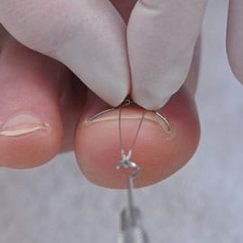 лечение вросшего ногтя без хирурга