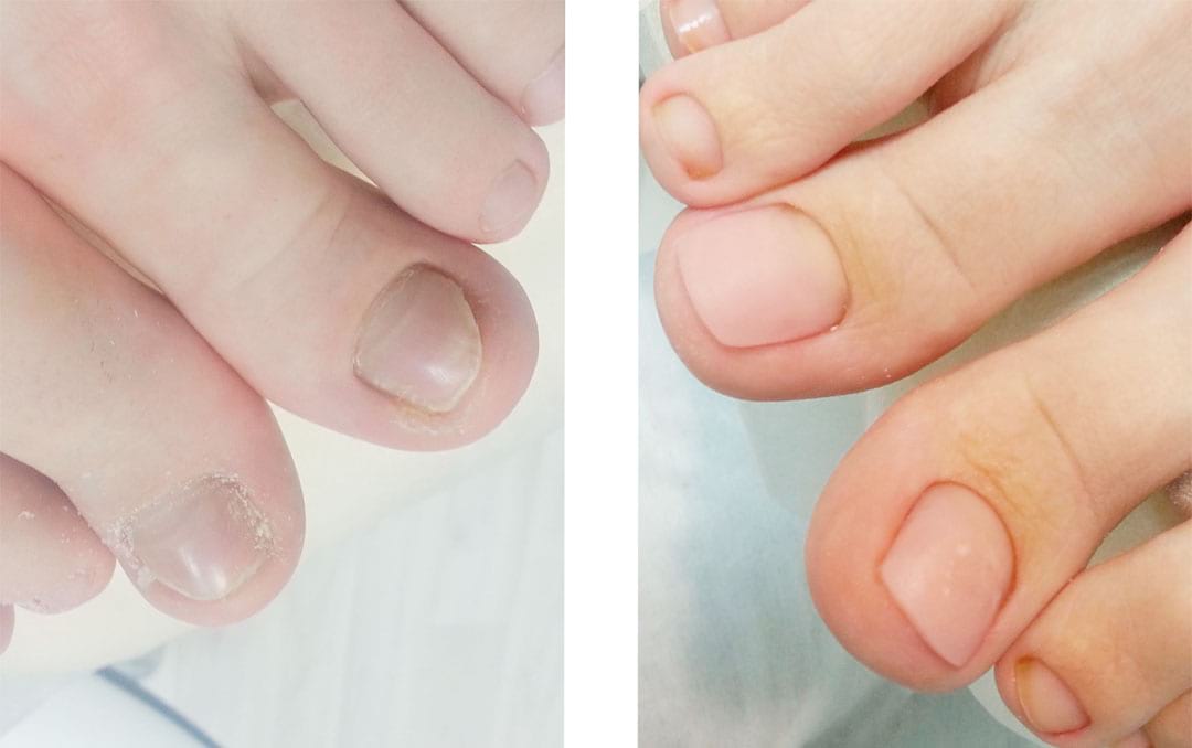 Протезирование ногтей на пальцах ноги