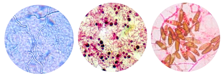 Соскоб ногтя. Грибковые поражения микроскопия. Грибок ногтей микроскопия. Микроскопия грибковых заболеваний.